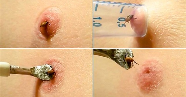 How to remove a tick the most efficient way