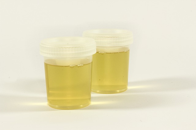 Changes in urine that indicate health problems