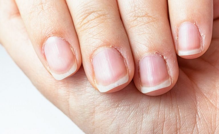 what-causes-the-skin-around-the-nails-to-break-and-why-is-it-so-painful