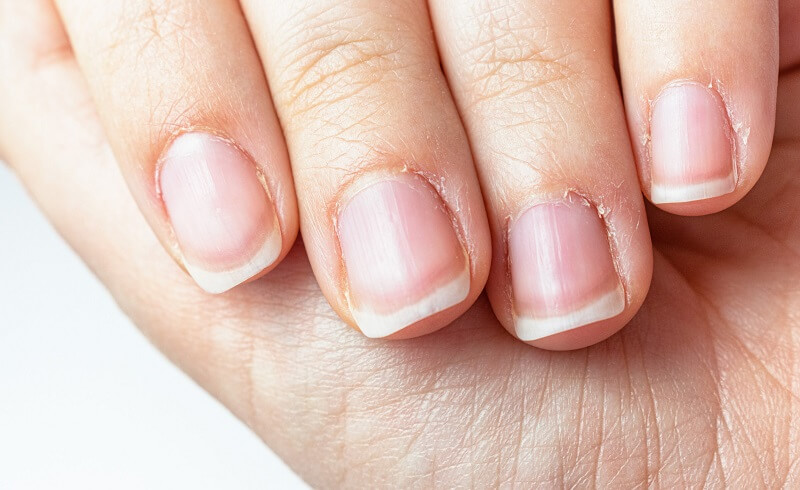 What Causes The Skin Around The Nails To Break And Why Is It So Painful 